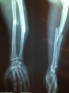 broken bone injury